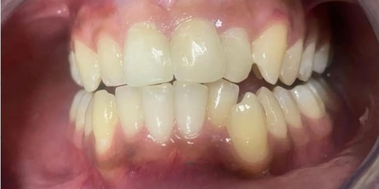 After dental treatment