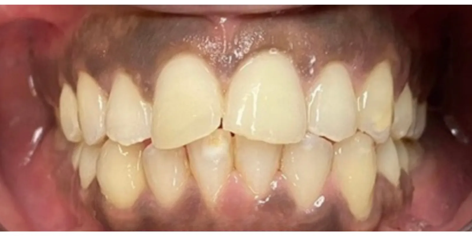 After dental treatment