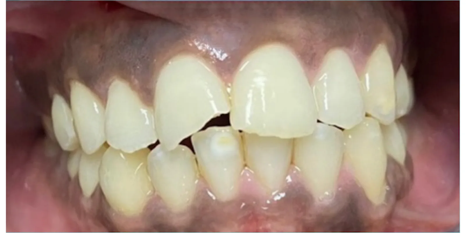 Before dental treatment